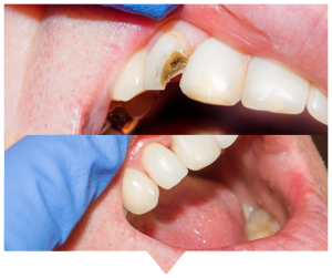 dental-bonding dental bonding before and after blarney dental