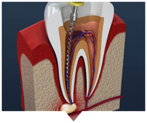 root-canal-treatment-blarney root canal treatment blarney