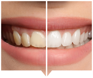 teeth-whitening teeth whitening dental care smile before and after